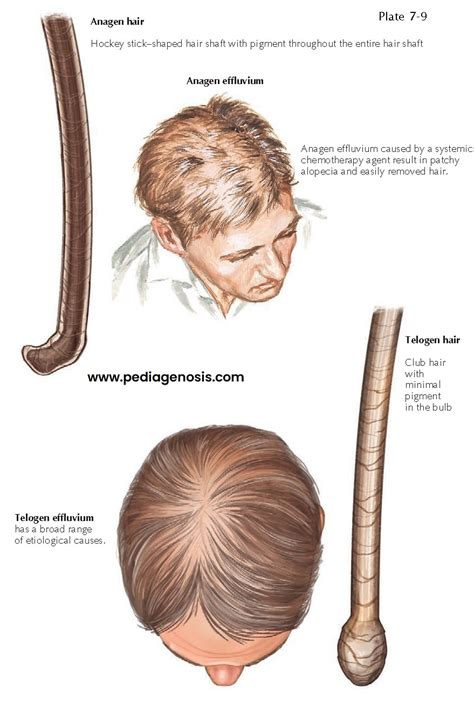 Telogen Effluvium And Anagen Effluvium Pediagenosis