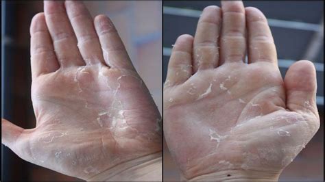 हाथों की उखड़ती स्किन के आसन घरेलु उपचार - SKIN PEELING का इलाज