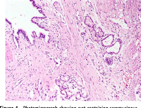 Figure From Mediastinal Bronchogenic Cyst Mimicking Congenital Lobar