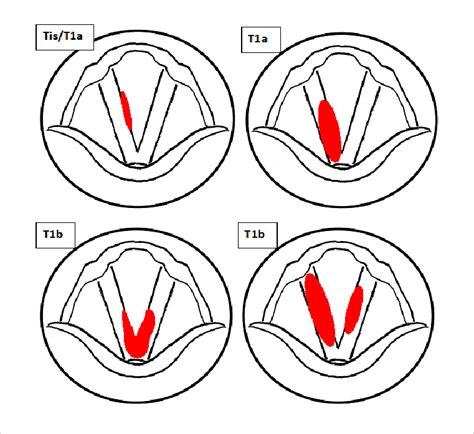 Examples Of T Stages For Early Glottic Cancer Download Scientific