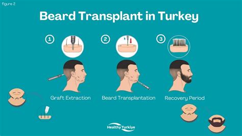 Beard Transplant In Turkey Check 2024 Cost And Prices