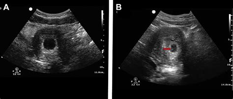 Ultrasound In Pregnancy Emergency Medicine Clinics