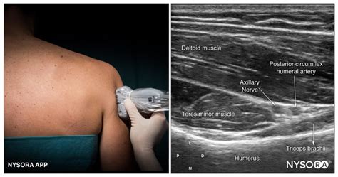 Axillary Nerve Block Ultrasound