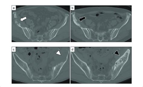 A Metastatic Bone Lesions In The Right Ilium Of A 77 Year Old Woman Download Scientific