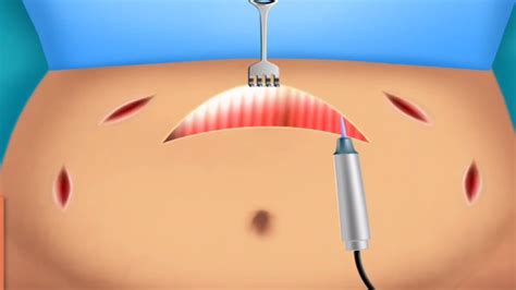 Tummy Tuck Surgery Animation Youtube