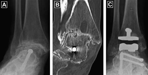 Salto Talaris Fixed Bearing Total Ankle Replacement System Clinics In