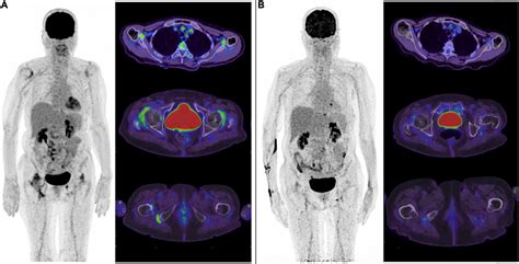 Frontiers 18F FDG PET Molecular Imaging A Relevant Tool To