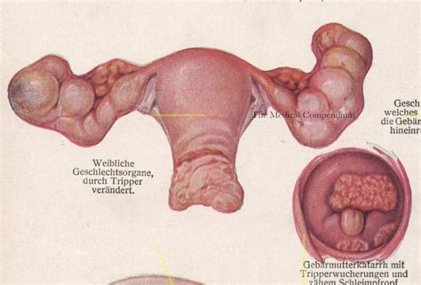 Vintage Venereal Disease Print Female Reproductive System Womens