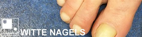 Witte Nagels Huidinfonl Dermatoloog