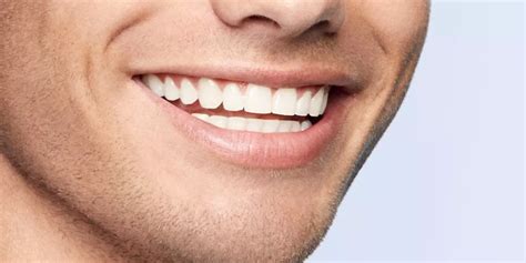 Lumineers Faccette Dentali No Prep Adesive