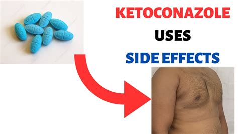 KETOCONAZOLE (NIZORAL) Uses- Side effects- Review: Shampoo, Cream, Soap ...