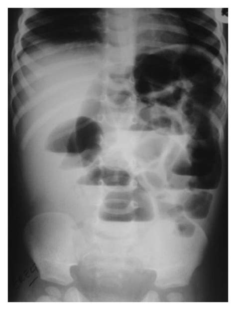 A plain abdominal X-ray shows small bowel intestinal obstruction. | Download Scientific Diagram