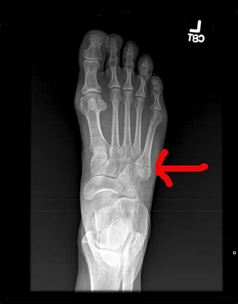 Pseudojones Fracture Or Dancers Fracture Of The Fifth Metatarsal Stock