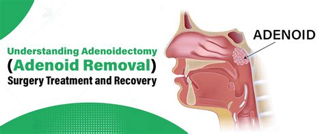 Understanding Adenoidectomy (Adenoid Removal): Surgery Treatment and Recovery