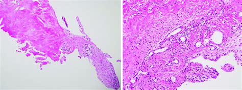 Surgical Pathology Of Plica In Patient With Internal Derangement Left