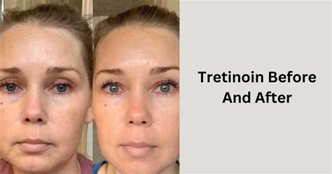 Tretinoin Before And After - Transform Your Skin!