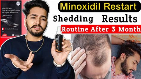 Minoxidil Restart 3 Month Complete Shedding Results And Routine YouTube