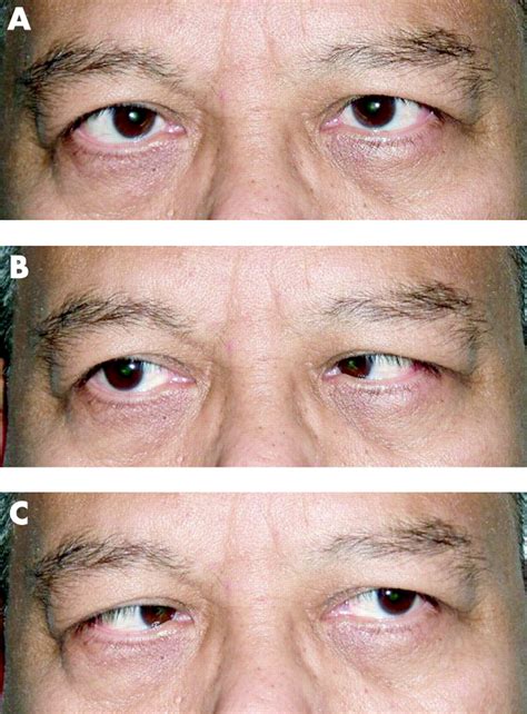 Microvascular Cranial Nerve Palsy