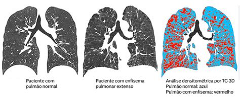 Pessoa Com Enfisema Pulmonar - Enfisema pulmonar: o que é, sintomas, causas e tratamento | Nav Dasa