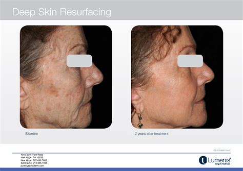 Co2 Laser Resurfacing — Board Certified Dermatology