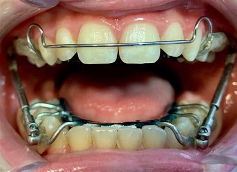 Appareil Dinterception Orthodontie Enfant Orthodontiste Bordeaux