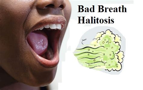 What Is Halitosis?