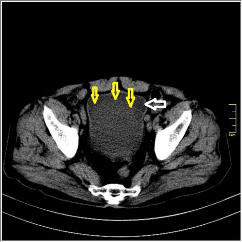 Radiopaedia Case Urinary Bladder Hematoma Id 59790 Study 67221 NC