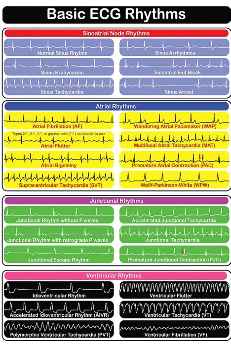 Basic Ecg Rhythms Poster