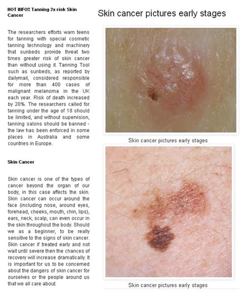 Skin Cancer Advices — Stages of skin cancer melanoma - Melanoma, basal...