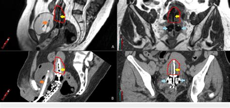 Magnetic Resonance Guided Brachytherapy A And B Show The Uterine