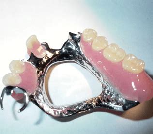 Metal Dentures Rosebud | Metal Denture Treatment Mornington Peninsula