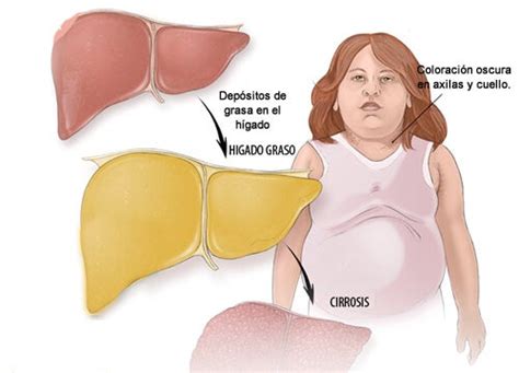 Consejos para combatir el hígado graso Mejor con Salud