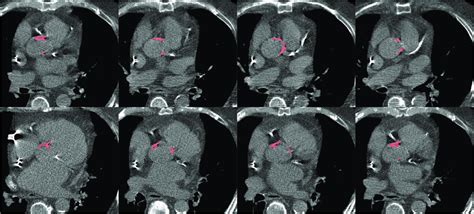 Multidetector Computed Tomography With Aortic Valve Calcium Score Of