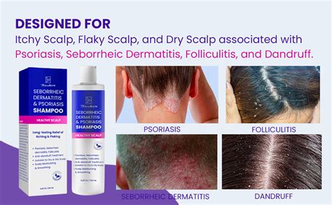 Mua Psoriasis Shampoo For Scalp Treatment Seborrheic Dermatitis Shampoo Antifungal Shampoo