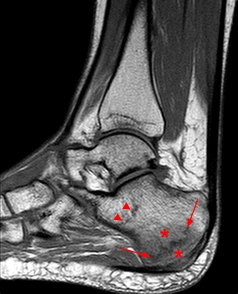 Stress Fractures In The Foot And Ankle