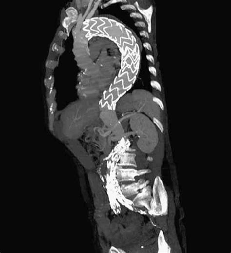 First Month Follow Up Reconstruction Of Ct Scan Showing Both Thoracic