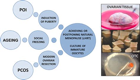 Frontiers Cryopreservation Of Ovarian Tissue Opportunities Beyond