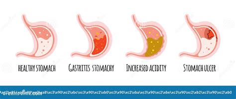 Gastritis And Stomach Ulcer Illustration High Res Vector Graphic The