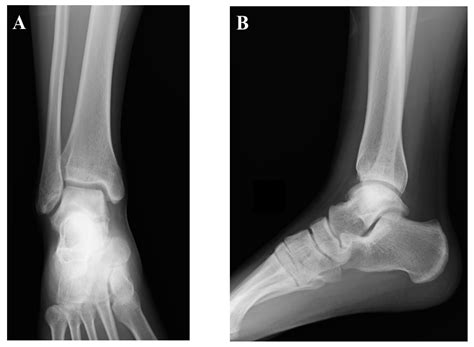 Talus Bone Treatment at Travis Munoz blog
