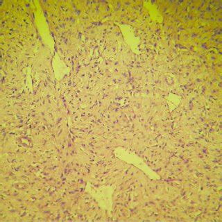 Histopathology Showing Interlacing Bundles Of Elongated Spindle Shaped