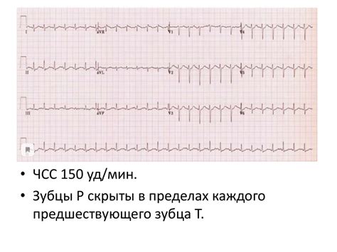 Аритмии - презентация онлайн