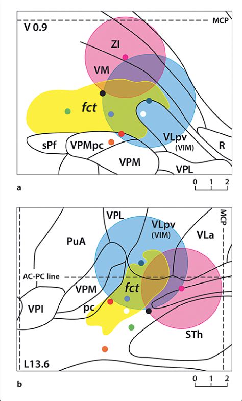 Projection Of The 2 Mean Stimulation Coordinates And Vta In Patients Download Scientific