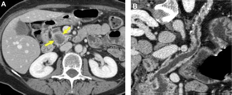 Incidental Pancreatic Cysts On Cross Sectional Imaging Radiologic Clinics