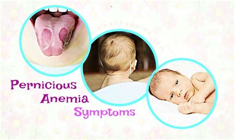 22 Pernicious Anemia Symptoms In Infants & Adults And Treatments