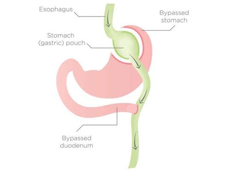 Total Gastrectomy With Roux En Y Esophagojejunostomy