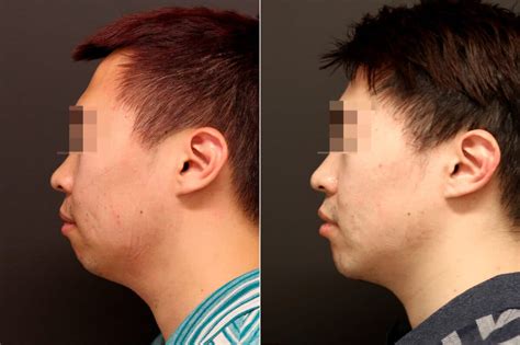 Chin Implants Photos | Princeton, NJ | Patient 10075