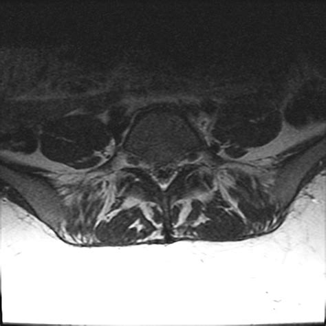 Bulging Disc Lumbar Spine MRI