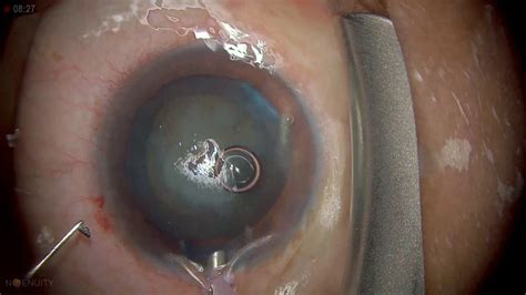 Surgery Phacoemulsification In Posterior Subcapsular Cataract YouTube