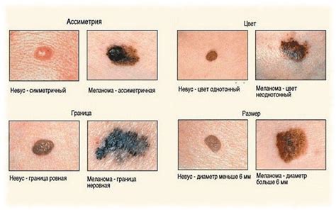 Почему появляются родинки? Причины, что делать, фото и видео - Научно ...