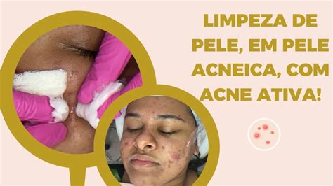 Limpeza De Pele Profissional Em Pele Acneica Acne Ativa YouTube